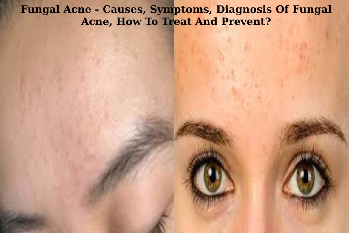 Fungal Acne Fungal Acne