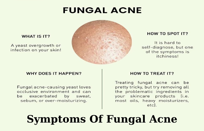 Fungal Acne - Causes, Symptoms, Diagnosis, How To Treat And Prevent?