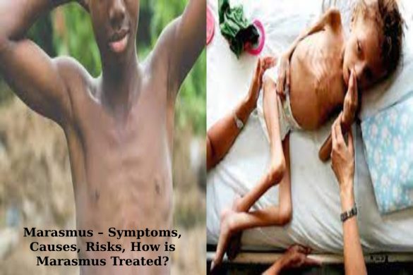 Marasmus