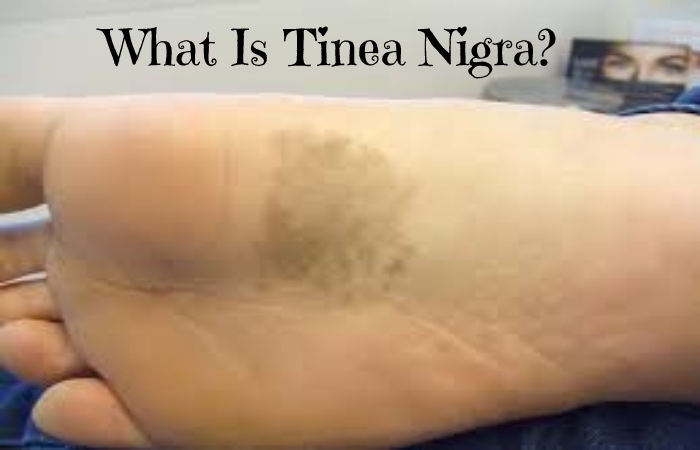 Tinea Nigra (1)