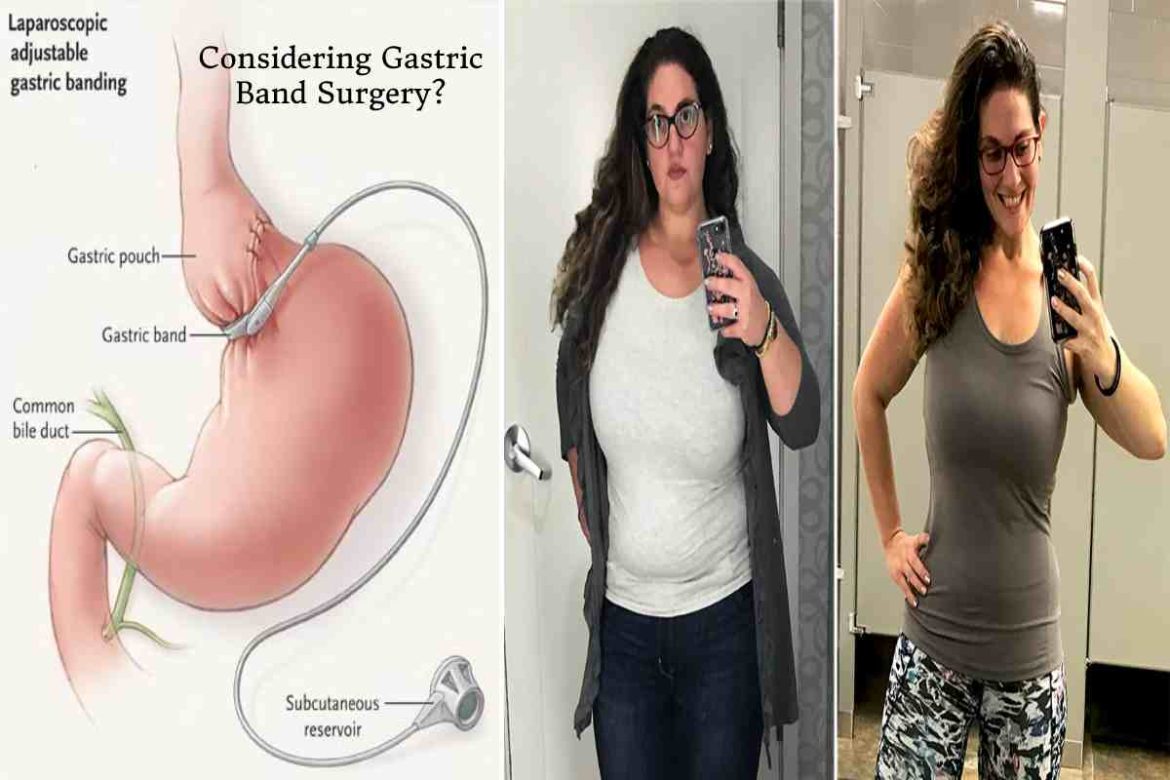 Considering Gastric Band Surgery_