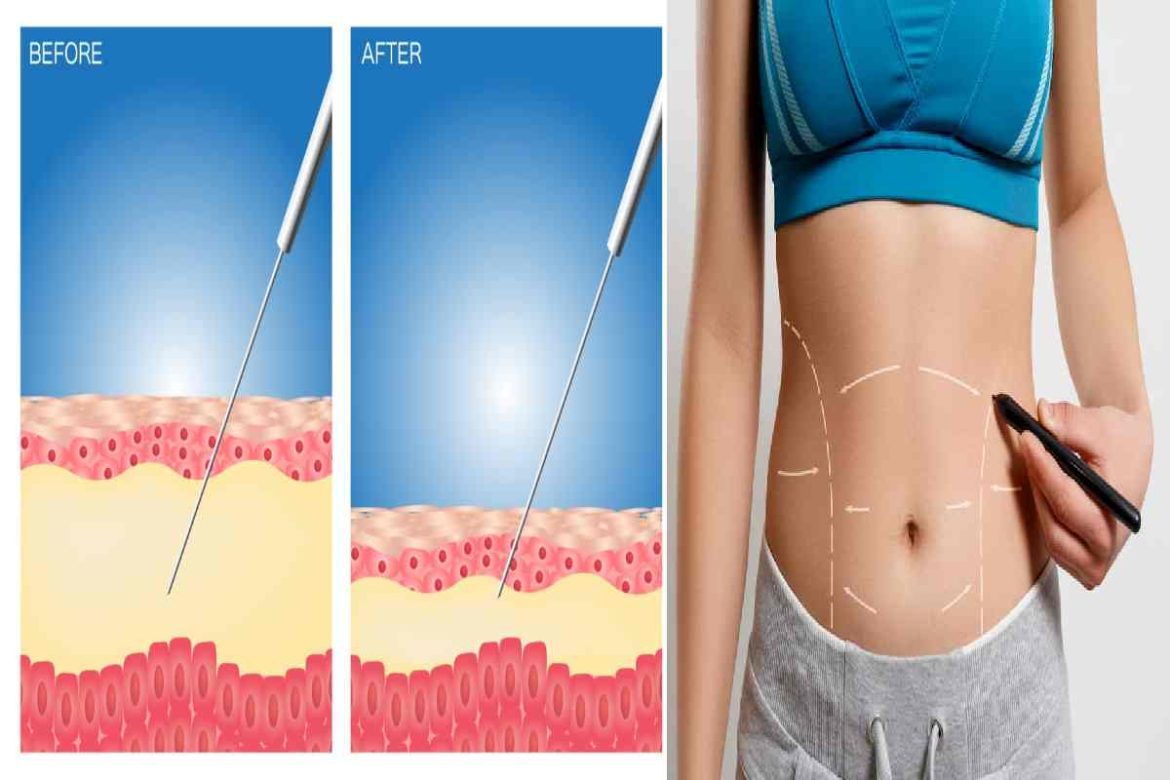 Difference Between Liposuction and Tummy Tuck