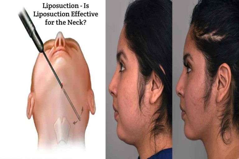 Is Liposuction Effective for the Neck