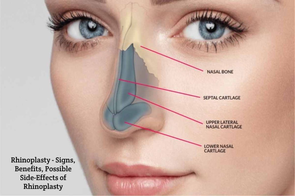 Rhinoplasty