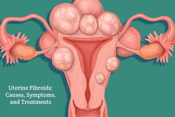 Uterine Fibroids