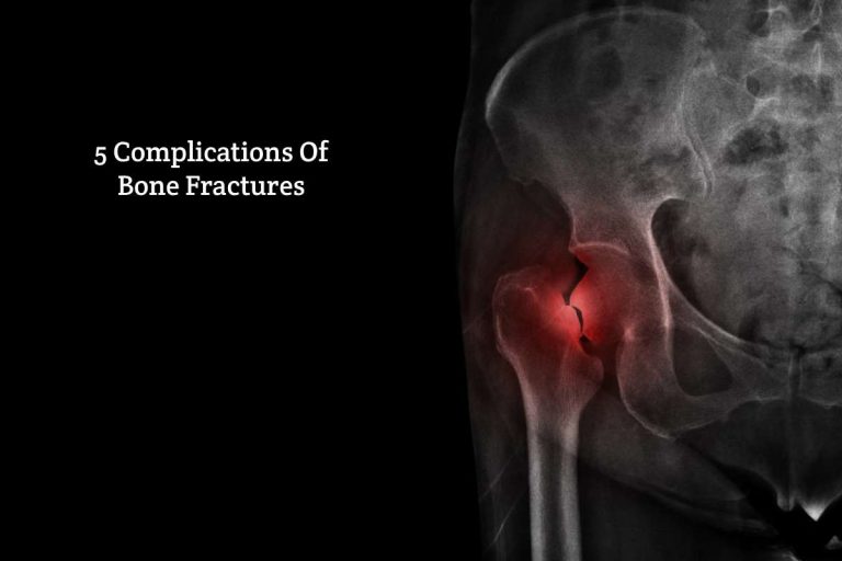 5 Complications Of Bone Fractures