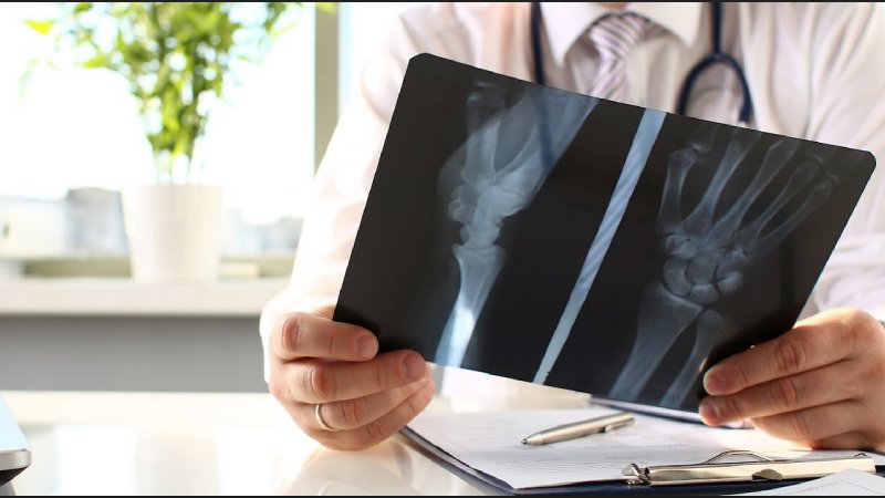 5 Complications Of Bone Fractures