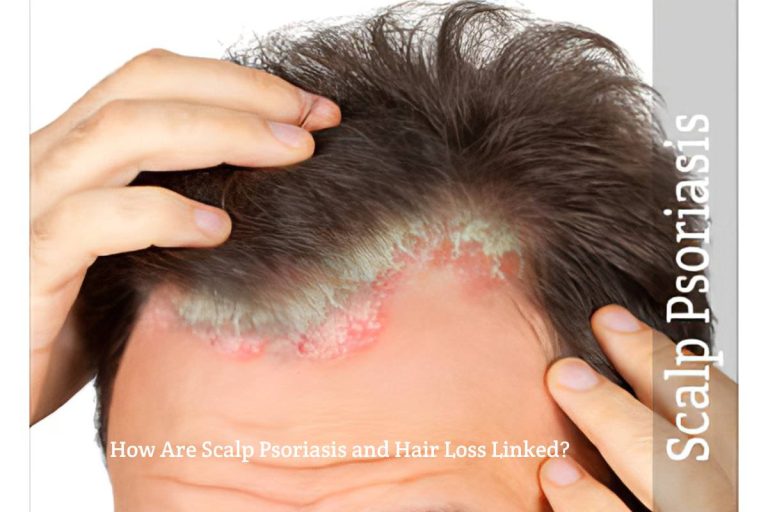 Scalp Psoriasis and Hair Loss Linked