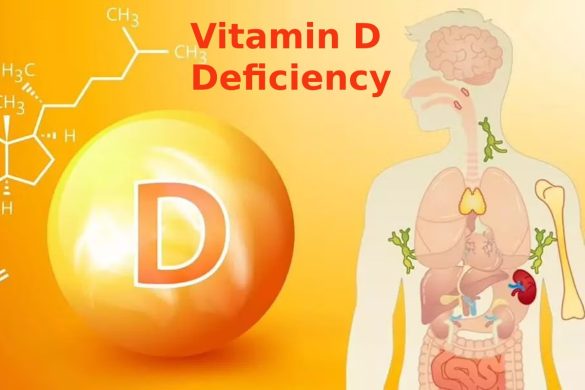 Vitamin D Deficiency: Know the Symptoms and Treatment