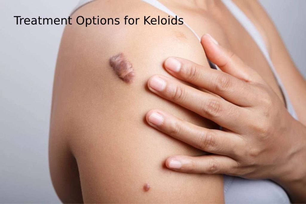 Treatment Options for Keloids