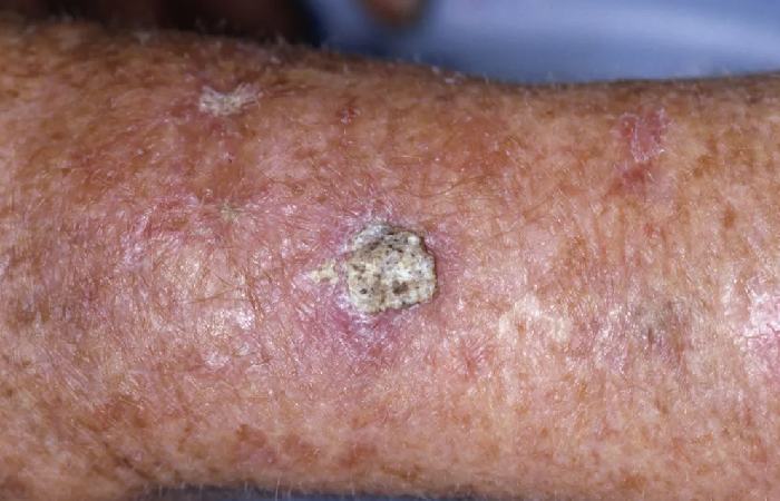 Skin Cancer