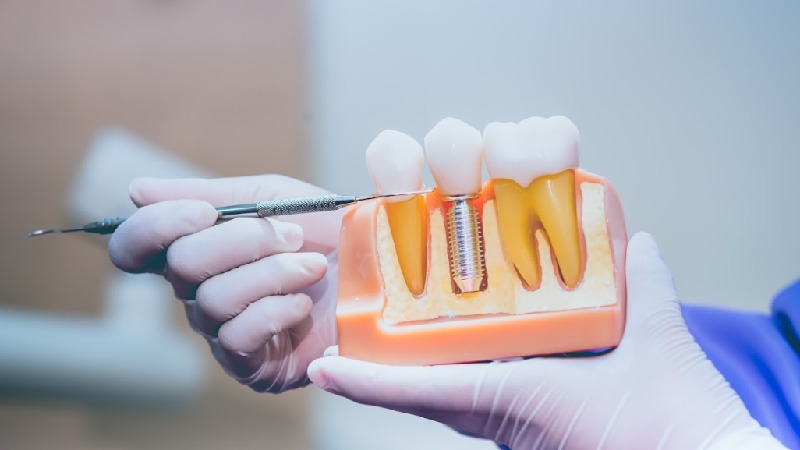 The Pros And Cons Of Getting Dental Implants 