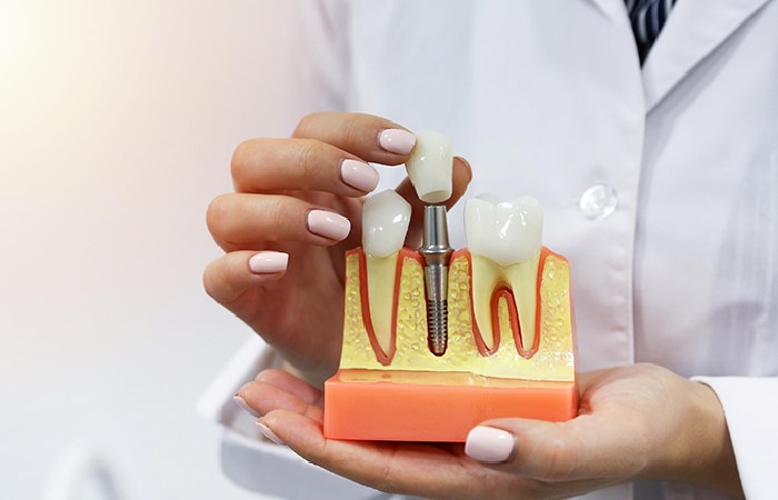 The Pros And Cons Of Getting Dental Implants