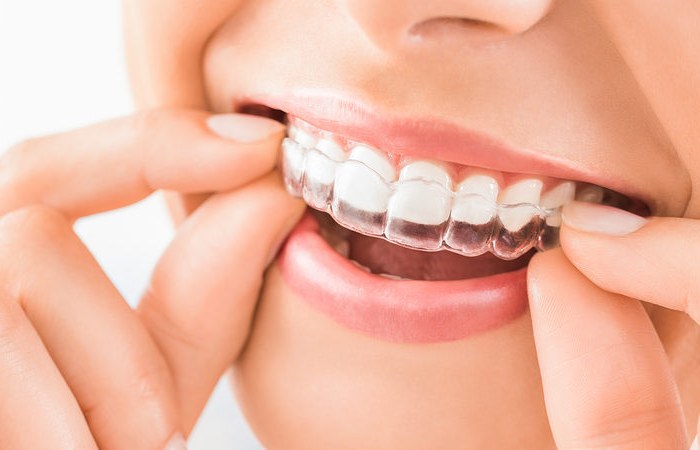 Invisalign vs. Braces