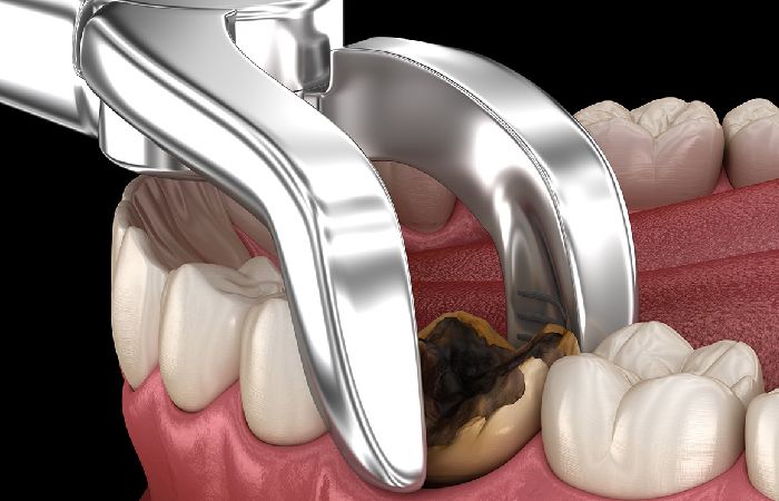 Tooth Extraction Procedural Details