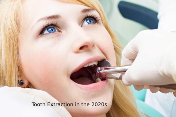 Tooth Extraction in the 2020s