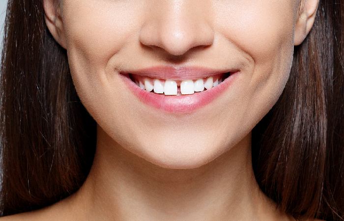 Main Differences between Veneers and Implants