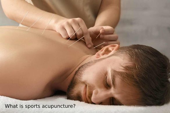 What is sports acupuncture_