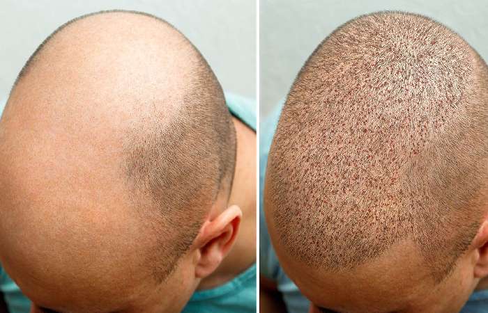 Hair Transplant Write for Us 