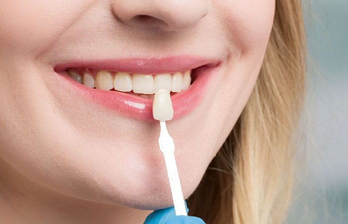 Porcelain Veneers Write For Us 