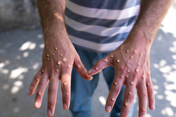 What you should know about monkeypox_