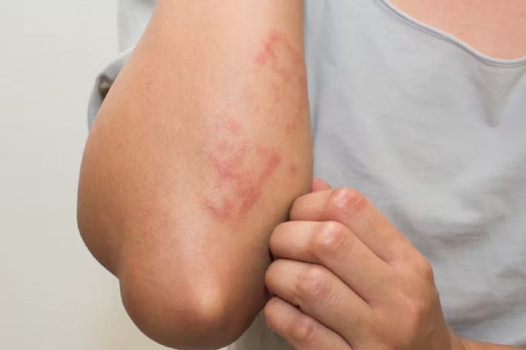 Skin Rash