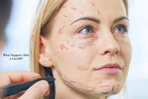 What Happens After a Facelift_ What Happens After a Facelift_