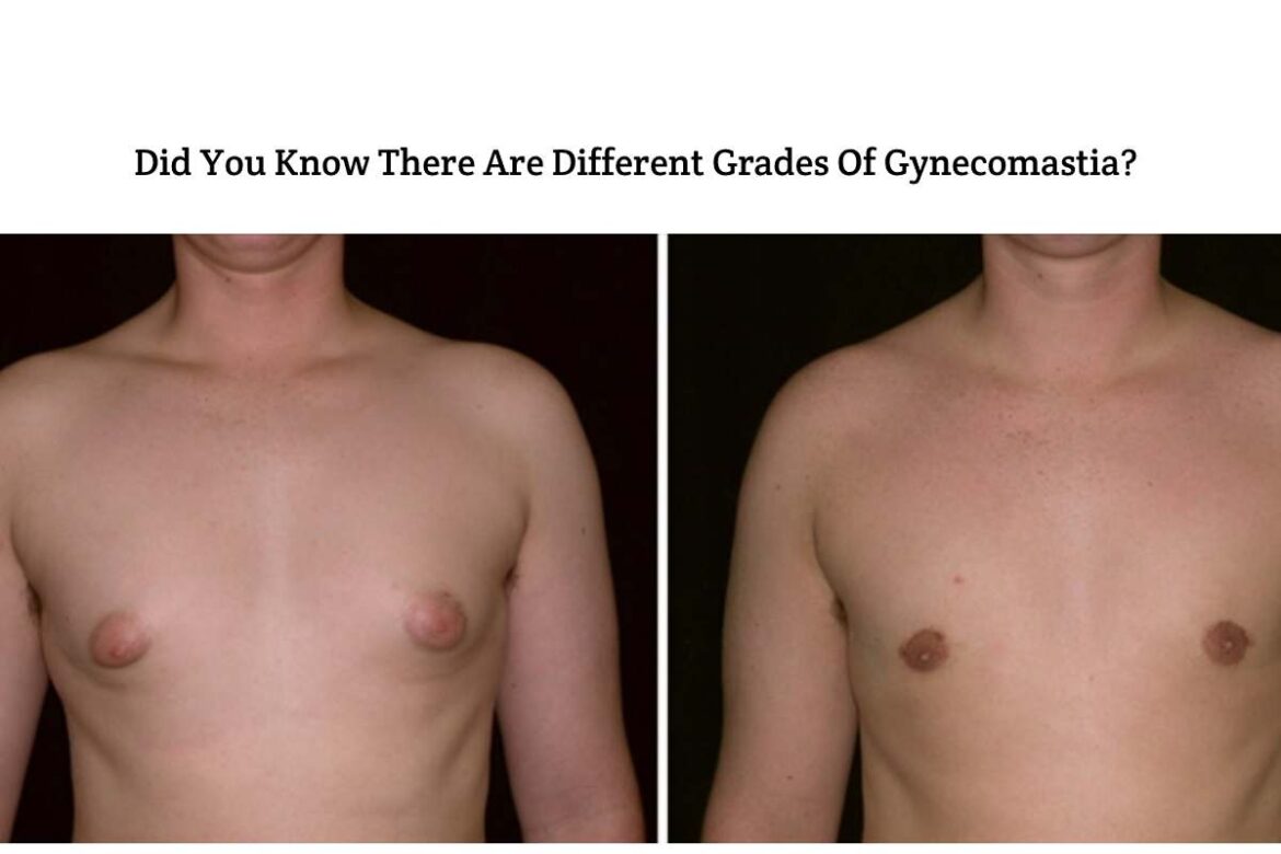 Different-Grades-Of-Gynecomastia