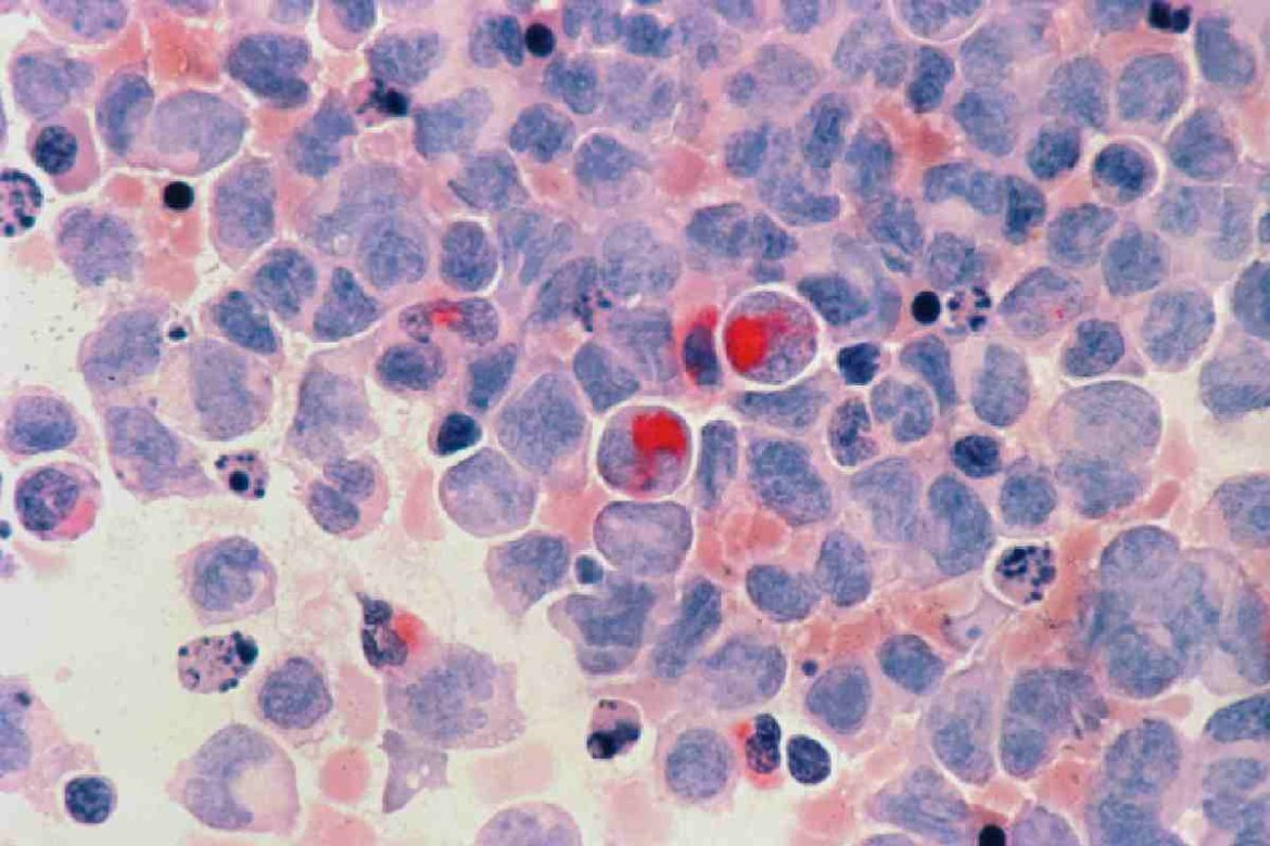 What Can You Do to Prevent Cancer_