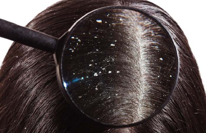 Controls Dandruff