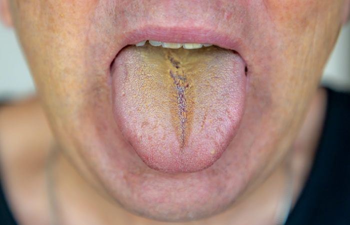 What Are Mouth Ulcers And How Are They Treated_ 