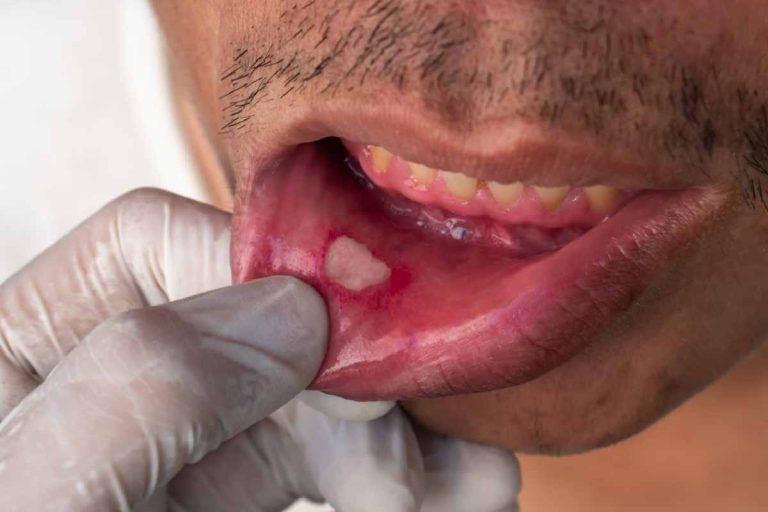 What Are Mouth Ulcers And How Are They Treated_