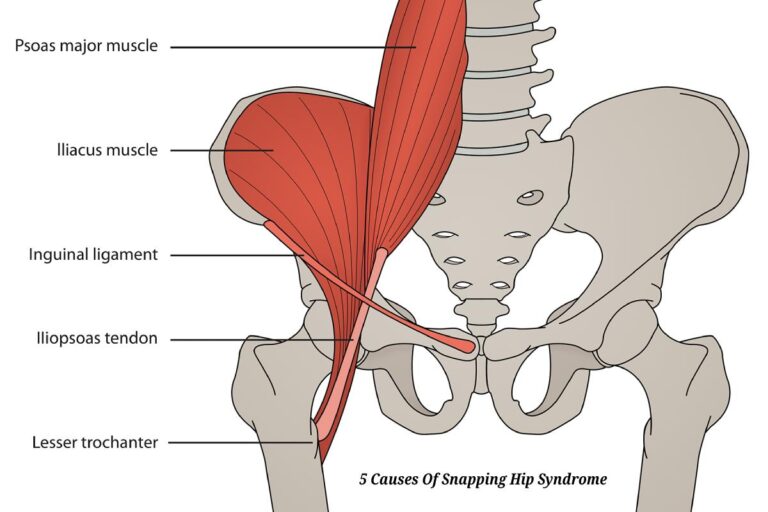 5-Causes-Of-Snapping-Hip-Syndrome