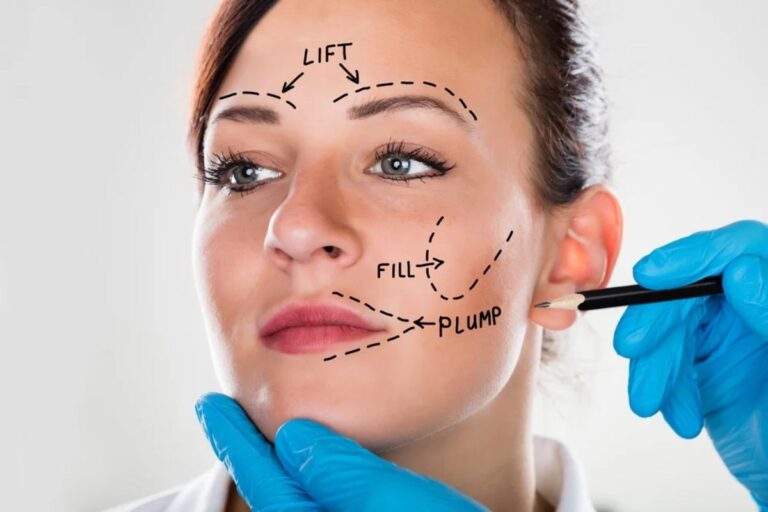 What Happens After a Facelift
