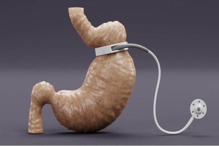 gastric band surgery