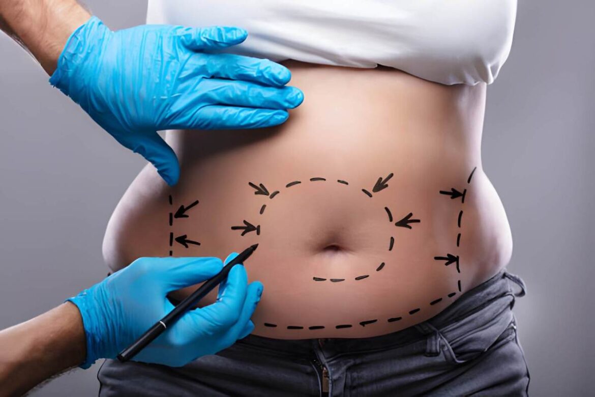 tummy tuck surgery