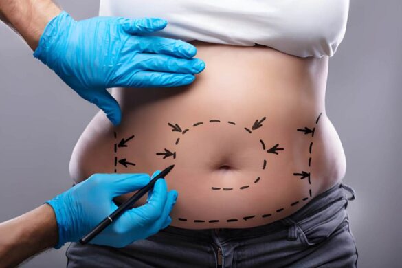 tummy tuck surgery