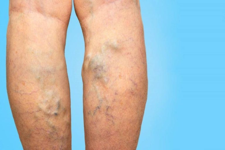 cosmetic vein issues
