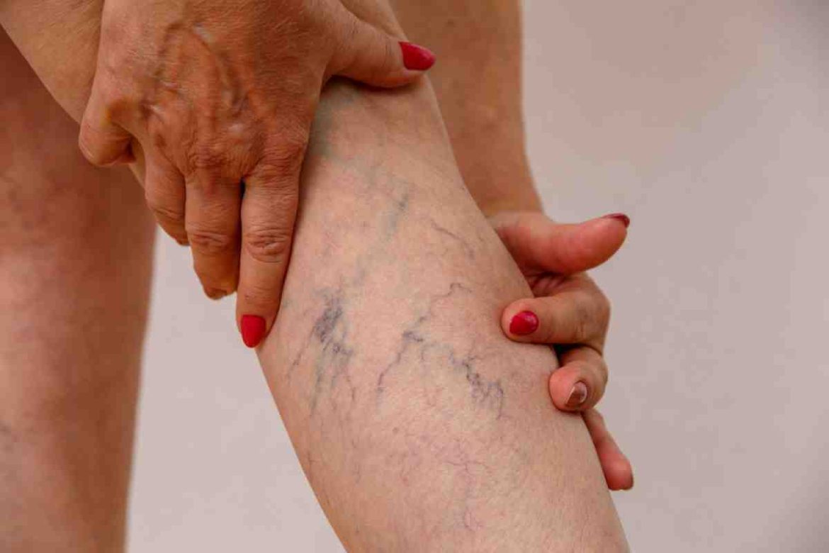 Varicose Veins Varicose Veins