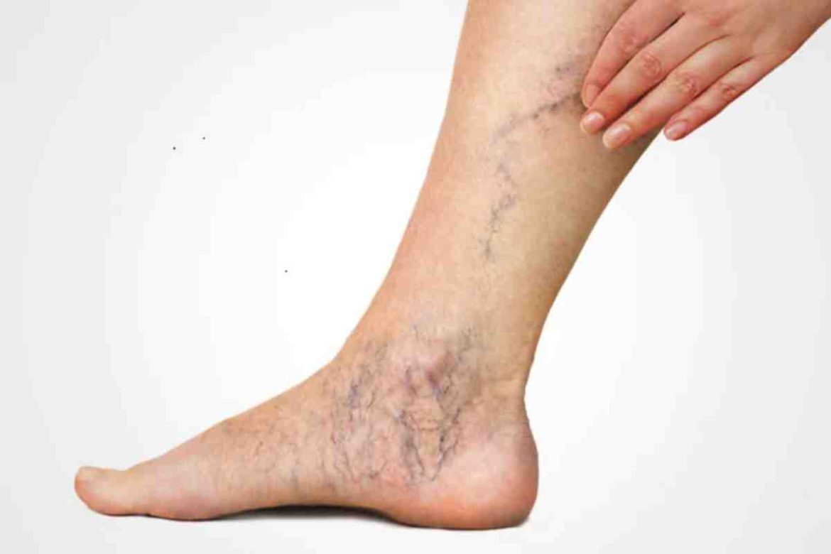 Varicose veins