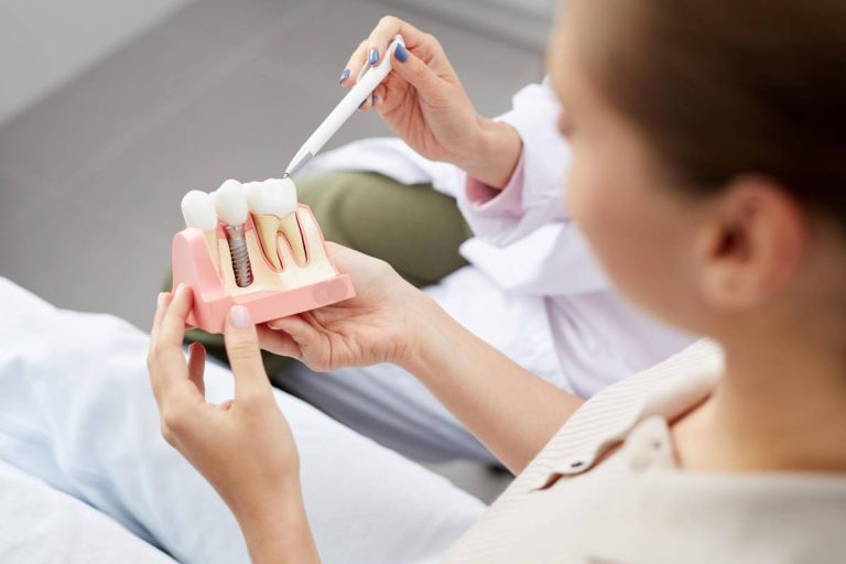 All On 4 Dental Implants