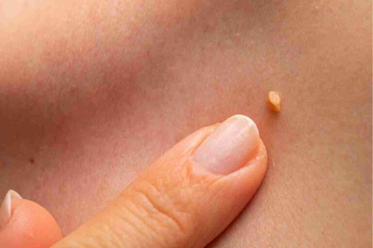 Wart-Removal (1)