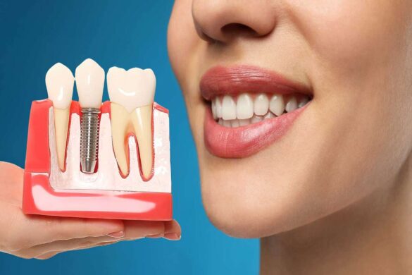 dental implants 