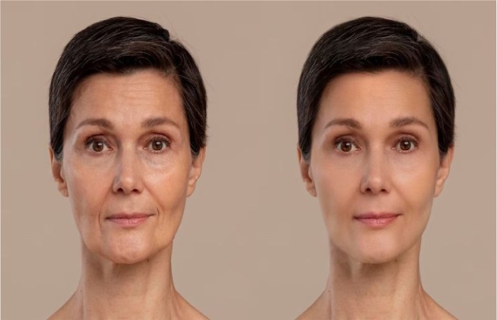 Face Lift Surgery Write For Us