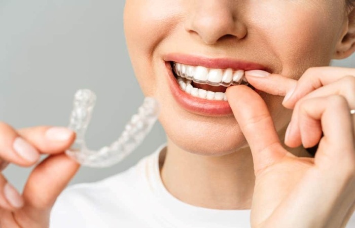 Invisible Braces Write for Us