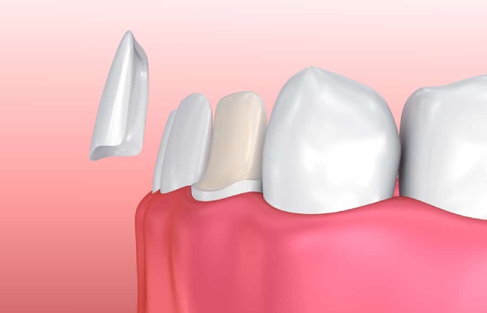 Porcelain Veneers Write For Us