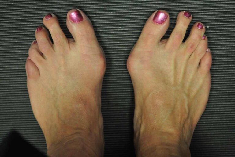 BUNION