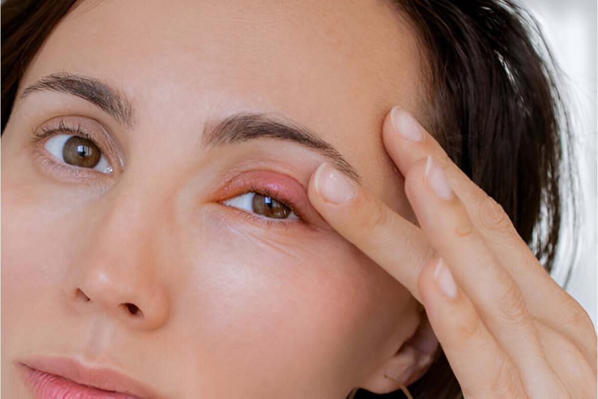 The Most Common Causes of Painless Eyelid Swelling