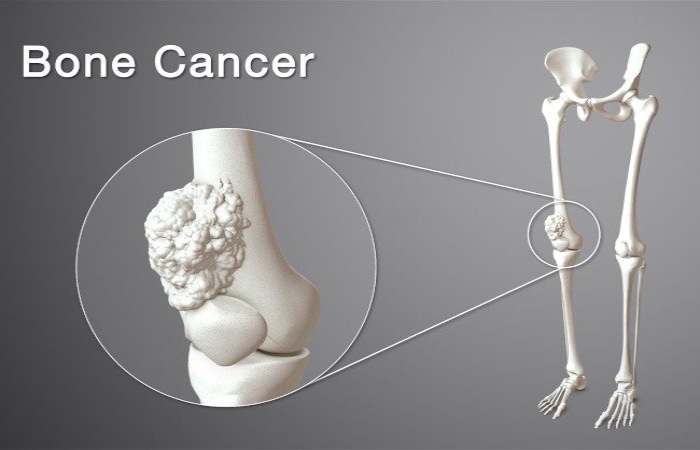 Bone Cancers
