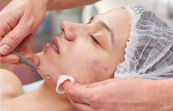Acne Removal Treatment